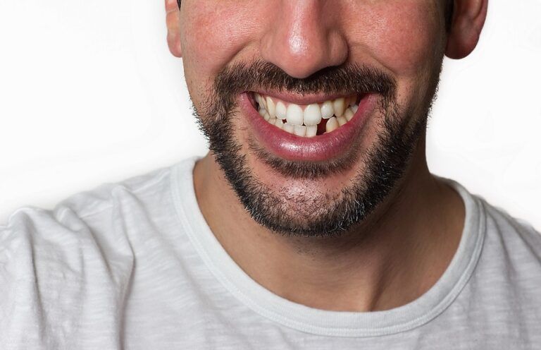 pérdida dental en Baeza