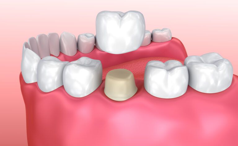 Implantes Dentales En úbeda