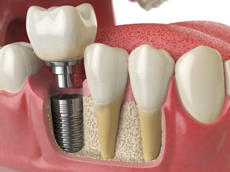 Implantes Dentales En Baeza